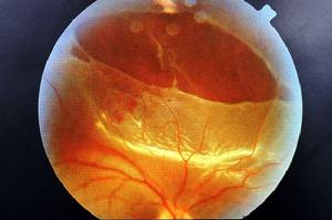 视网膜脱落怎么?