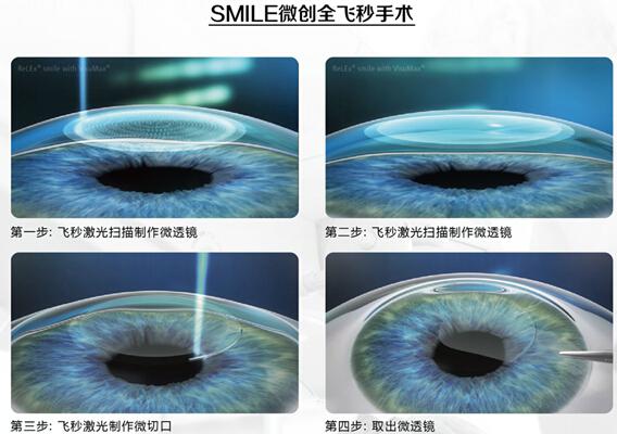 重庆普瑞眼科医院 全飞秒近视手术过程