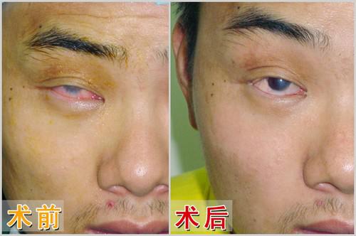 重庆晨报：普瑞眼科为重庆小伙免费进行角膜移植手术