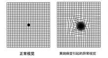 黄斑病变应及时就医