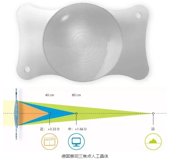 我院实施蔡司三焦点人工晶体植入手术