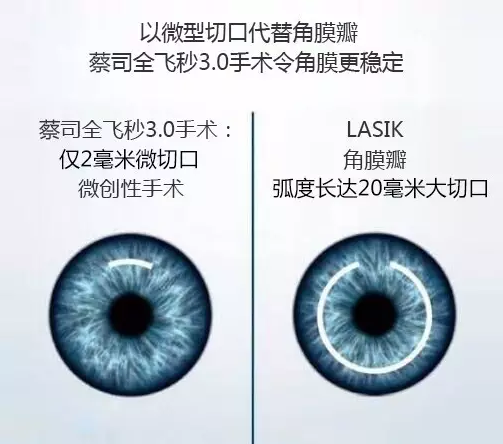 全飞秒SMILE3.0 手术五大优势