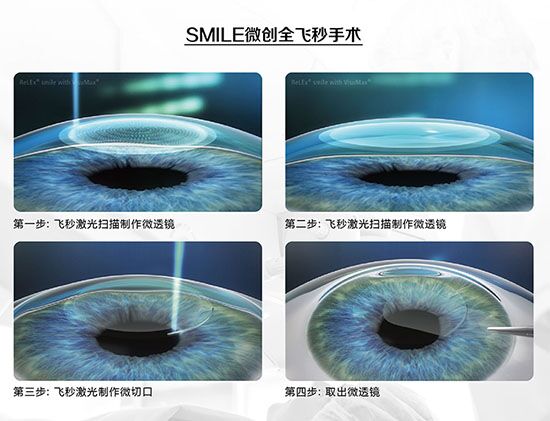 蔡司全飞秒、蔡司半飞秒近视手术与蔡司全飞秒flex手术