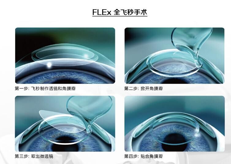 蔡司全飞秒、蔡司半飞秒近视手术与蔡司全飞秒flex手术