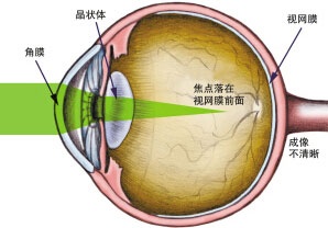 如何恢复视力?