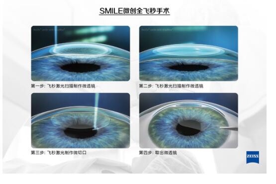 准分子激光手术到底是怎么治 愈你的眼睛的？