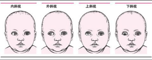 重庆斜视该怎么？