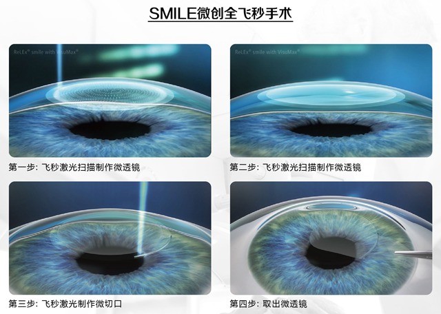 近视手术多少钱？关键要看这几点