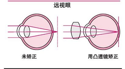 “少花眼”——年轻人的老花眼